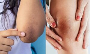 Darkness Removal Mask For Knees And Elbows: इस तरह से बनाएँ मास्क और डार्कनेस छुटकारा पाएँ