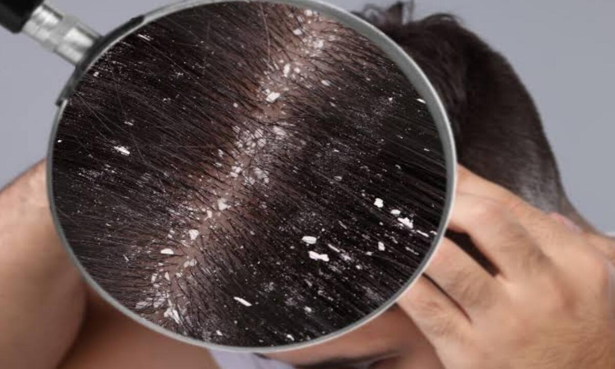 Dandruff Hair Care
