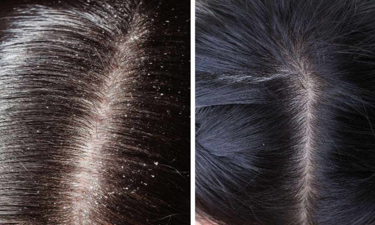 Dandruff Hair Care